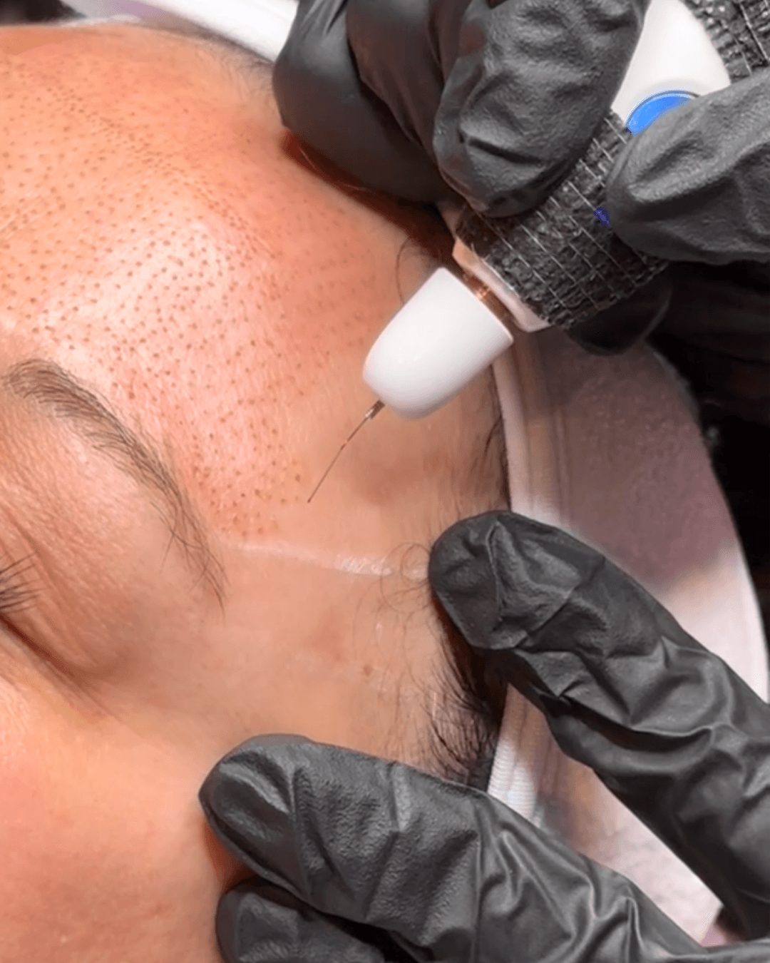 A person receives a facial treatment with a device, while a technician wears black gloves and holds the device on the face.