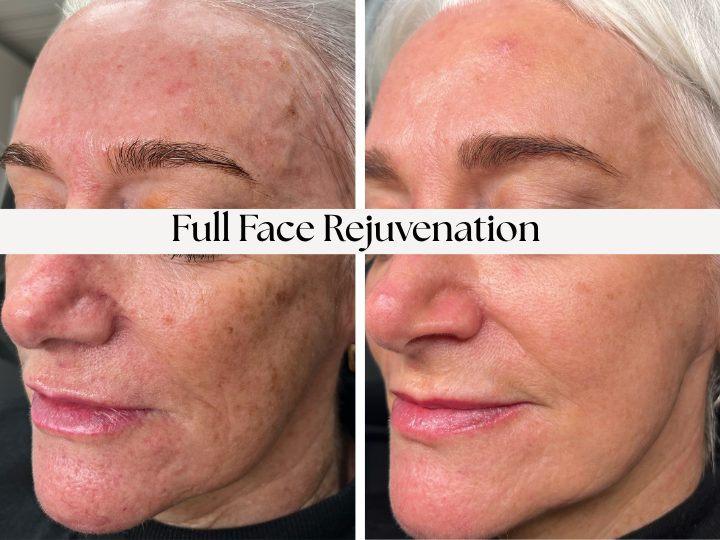Before and after images showing facial skin improvement after rejuvenation, with visible reduction in blemishes and wrinkles.