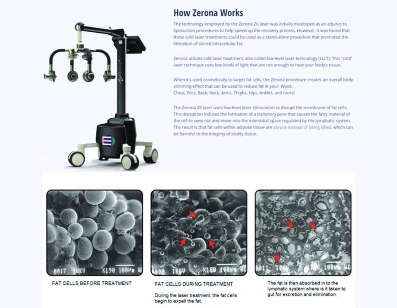 Medical device with robotic arms and wheels, and three microscopic images showing fat cells before and after treatment, with red arrows.