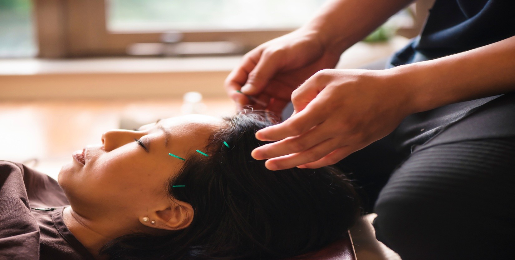 Person lying down with eyes closed, receiving acupuncture treatment on head from practitioner.